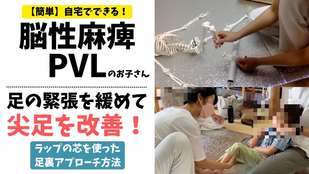 脳性麻痺、PVL（脳室周囲白質軟化症）の尖足を改善する足裏へのアプローチ方法