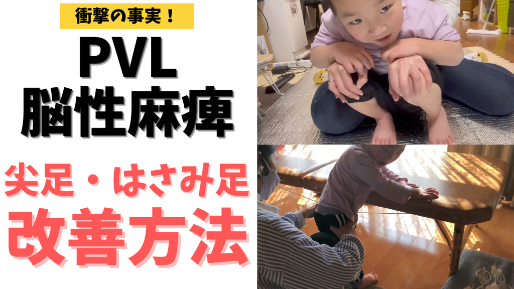 【衝撃の事実】PVL・脳性麻痺のお子さんの尖足の改善方法
